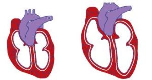 el corazón de las personas afectadas también puede dilatarse y agrandarse sin cumplir bien la función de recibir y enviar la sangre al organismo.