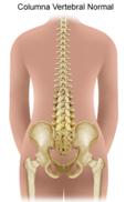 la escoliosis es un encorvamiento lateral no natural de la columna vertebral. Esta condición se puede dar en los niños por diversas razones.