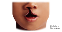 Labio hendido unilateral; la hendidura está sólo en el labio y puede variar enormemente, desde leve (muesca del labio) hasta severo (gran abertura desde el labio hasta la nariz)