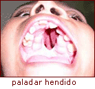 Paladar secundario hendido; la hendidura se localiza en el paladar tanto duro como blando