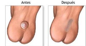 El bebé deberá permanecer en el hospital para vigilancia constante. La posición ideal durante los primeros días es boca abajo para evitar que la orina y las heces fecales contaminen la herida.