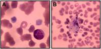 El Síndrome de Aldrich-Wiskott y mutaciones GATA-1 forman parte de un grupo de padecimientos que se heredan en forma recesiva ligados al cromosoma X (el cromosoma del sexo) los cuales se expresan como mujeres portadoras asintomáticas y hombres portadores enfermos.