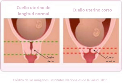 cuello uterino
