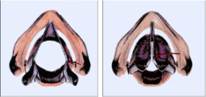 Las cuerdas vocales: La laringe contiene también a las cuerdas vocales y permite el mecanismo de la fonación diseñado específicamente para la producción de la voz