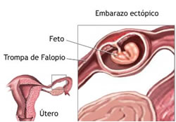 ¿Qué es el embarazo ectópico
