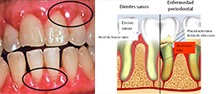 Cuando la gingivitis no es atendida a tiempo, puede desencadenarse La Enfermedad Periodontal, que es la inflamación e infección de las encías y de las estructuras que sostienen al diente.