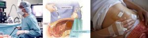 La endometriosis solo puede diagnosticarse por medio de una laparoscopía
