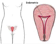 La palabra “Endometriosis” viene de “endometrio” que es el tejido que recubre el interior del útero.