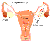 ¿Qué pasa en la endometriosis?