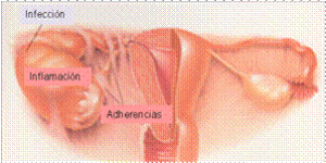 ¿Cuáles son los síntomas de la endometriosis?
