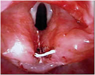 Cuando los trastornos respiratorios son demasiado frecuentes, puede ser que el médico decida que es necesaria la cirugía. El postoperatorio de estos bebés es complicado.