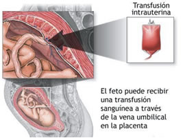 ¿Cuál es el tratamiento del Hydrops Fetalis?