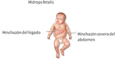 Hidropesía Fetal