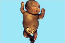 ¿Cómo afecta la hidropesía fetal a mi bebé?