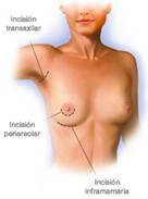 ¿Qué importancia tiene la forma en la que me pusieron los implantes?