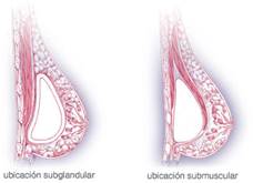 ¿Qué importancia tiene la forma en la que me pusieron los implantes?