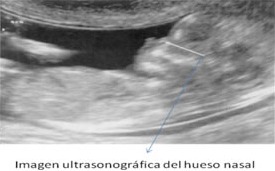 Este hallazgo también se utiliza como marcador ecográfico y requiere de una técnica específica para su observación
