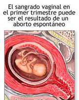 el sangrado vaginal en el primer trimestre puede ser el resultado de un aborto espontáneo