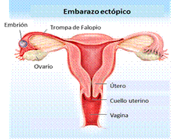 embarazo ectópico