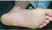 Hiperqueratosis difusa en la planta del pie de un adulto con Tirosinemia