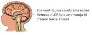 Aumento del LCRporque hay dificultades en el drenaje, o algún defecto en la reabsorción, o bien porque hay hiperproducción, o alguna malformación cerebral que forma parte de algún síndrome malformativo cerebral, lo que es causa de una Hidrocefalia