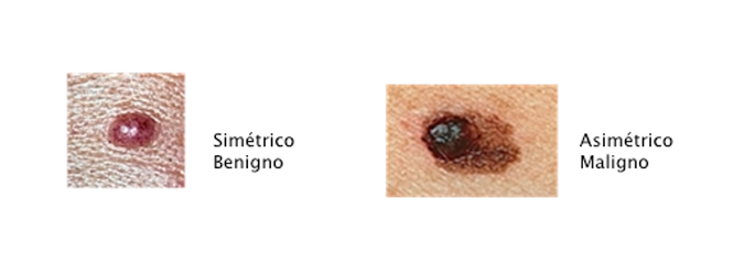 melanoma1