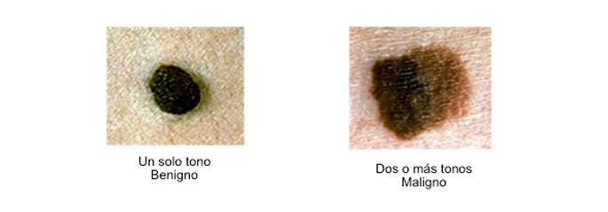 melanoma3
