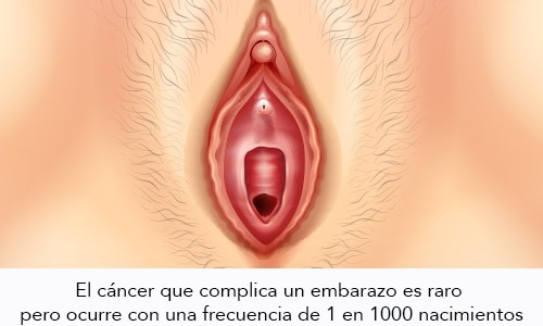 Cáncer de vulva y embarazo