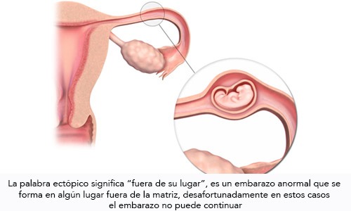 Embarazo Ectópico