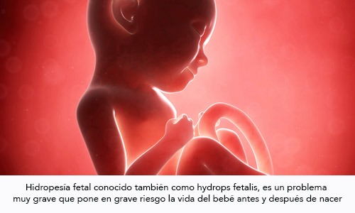 Hidropesia Fetal