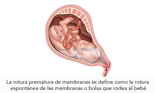 Ruptura o Rotura Prematura de Membranas