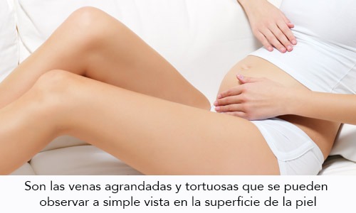 Varices en el Embarazo